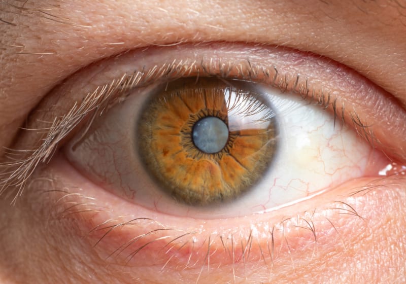 Konservative Augenheilkunde - Auge von einem Mann